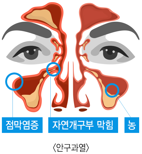 결막부종